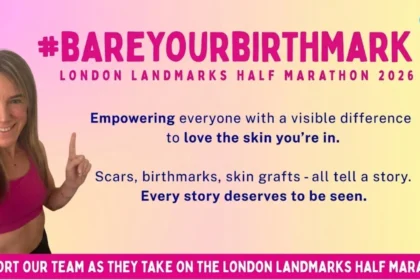 Women Bare Birthmarks at London Half Marathon to Challenge Congenital Naevus Stigma